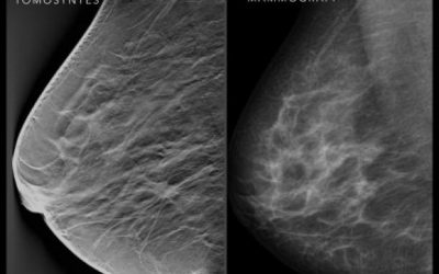 What is Breast Tomosynthesis – and is it Better Than Mammography?