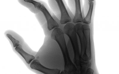 Dynamic Joint CT scans: Why and how they’re performed with the new Canon Aquilion ONE/GENESIS Edition CT scanner